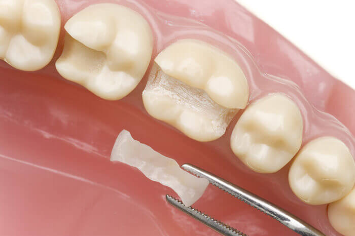 Cosmetic Dental Fillings